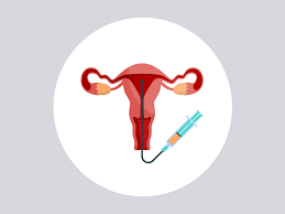 Intrauterine Insemination (IUI)